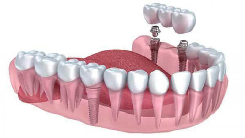 Intramucosal Implants have a more profound effect on the bone than dentures since they integrate the bone directly into the jawbone