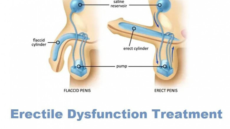 In the treatment of erectile dysfunction, erectile dysfunction devices have emerged as an ideal solution