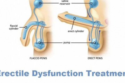 In the treatment of erectile dysfunction, erectile dysfunction devices have emerged as an ideal solution