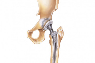 The major benefit of Bone Replacement Products is that they can be used for bony areas where the natural growth pattern is missing