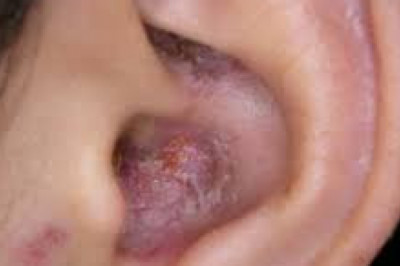 When not recognized and treated promptly, fungal otitis externa can prove fatal