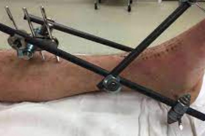 External Fixators are structures that are used to support surgical rods that are screwed into the bones.