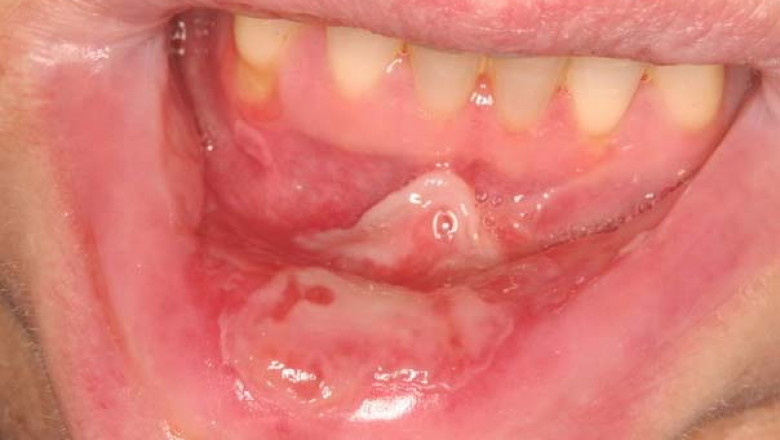 U.S. Severe Oral Mucositis usually affects the mouth and often results from cancer treatments