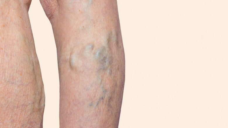 What are the Best Vein Treatment Options?