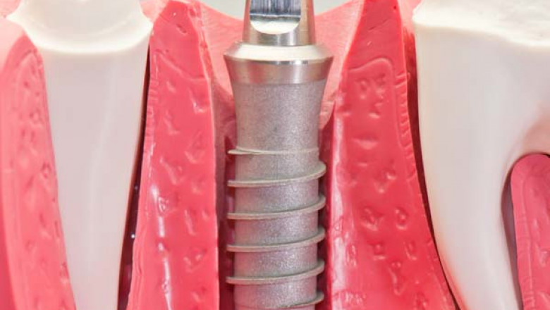 Everything you need to Know About a Dental Implant Procedure-