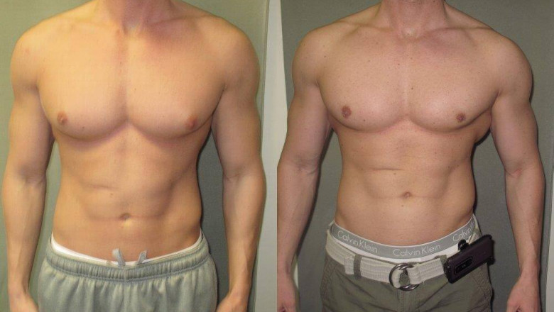 Get the Best Gynecomastia Surgery in India - DR viraldesai.Com