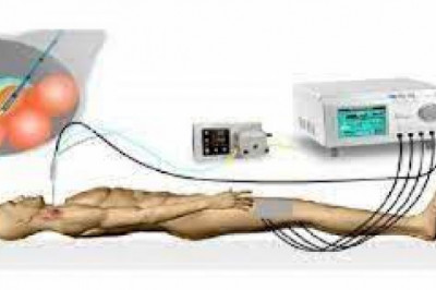 Radio Frequency Ablation Devices are sophisticated medical devices that are used to treat pain in a variety of surgical and non-surgical situations.