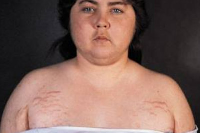 Cushings Syndrome Market Insights, and Forecast