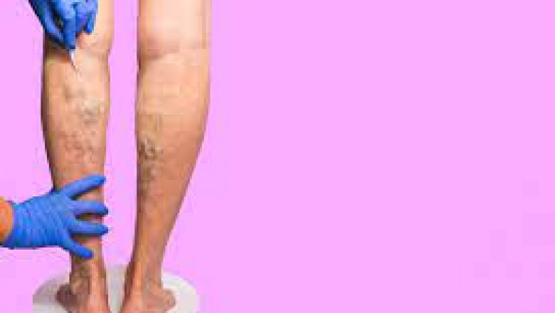 Vein Specialist: Which Varicose Vein Treatment is best for you?