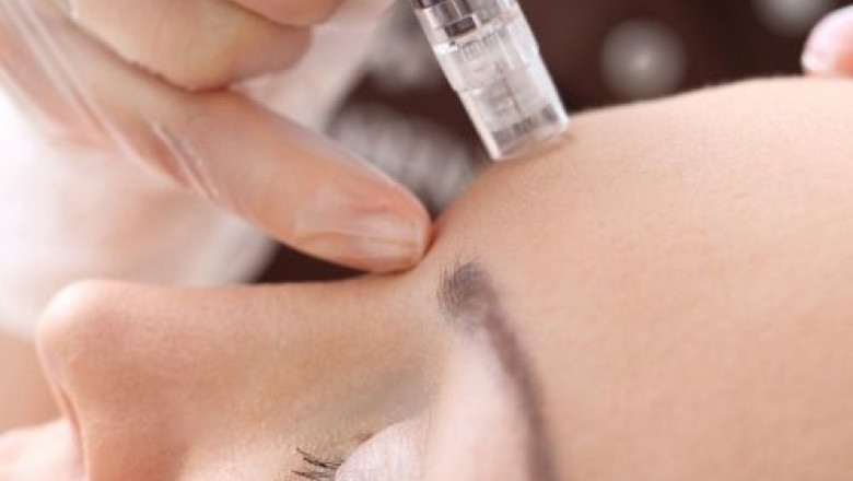 What is SkinPen treatment? | beautycenterhoofddorp