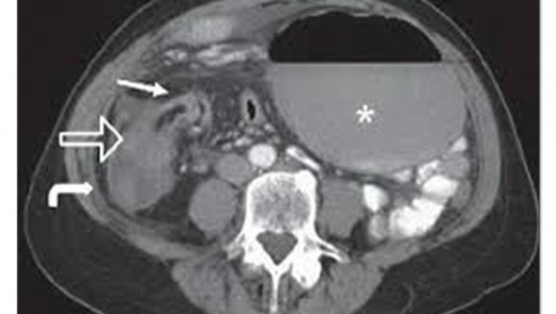 NATURAL TREATMENT FOR CECAL VOLVULUS