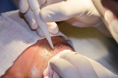 Completely Examine The Hair Transplant Establish you back Formerly You Devote