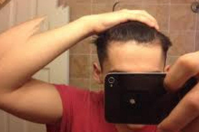 Men Hair Loss Causes and Treatments