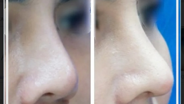 Frequently Asked Concerns About Rhinoplasty