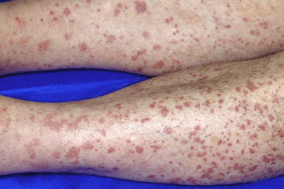 Vasculitis Treatment Market- Global Industry Analysis, Size, Share, Growth, Trends and Forecast