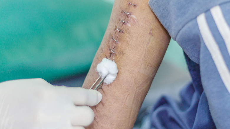 Surgical Staplers Market 2021 | Business Opportunities, Current Trends And Industry Analysis By 2027