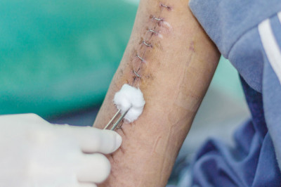 Surgical Staplers Market 2021 | Business Opportunities, Current Trends And Industry Analysis By 2027