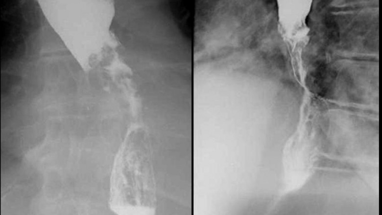 Esophageal Cancer Market Key Players, Growth Analysis, Top Manufacturers, Segmentation, Forecast Research, and Industry Demand by 2027