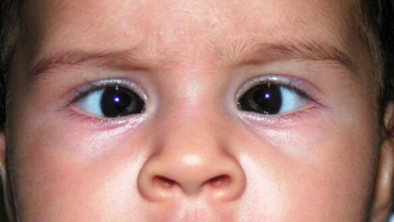 Don't Neglect Squint Eyes