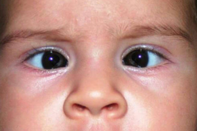 Don't Neglect Squint Eyes