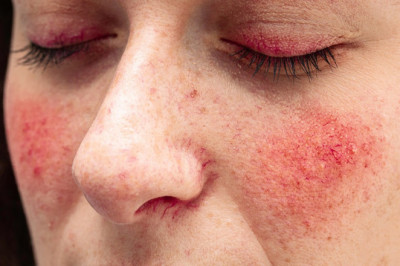 How to clear rosacea?