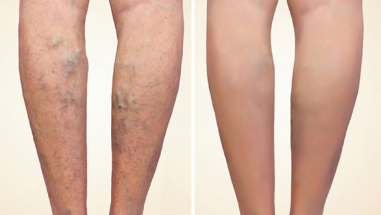 With the increasing prevalence of varicose veins, demand for Varicose Vein Treatment is also increasing with a rapid pace