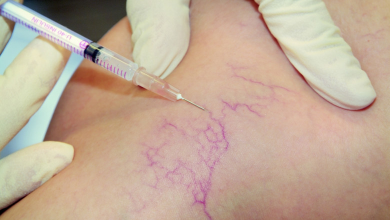 Microsclerotherapy Treatment Market: Global Industry Analysis and Opportunity Assessment