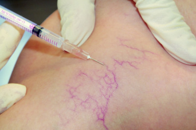 Microsclerotherapy Treatment Market: Global Industry Analysis and Opportunity Assessment