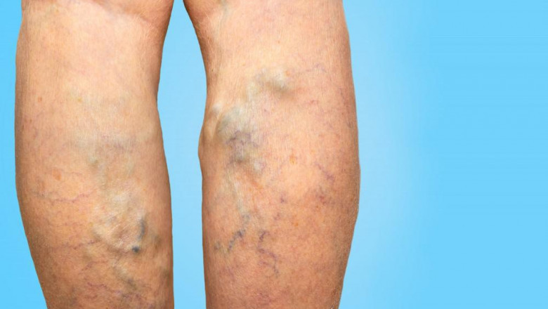 Read This Guide Opt For Varicose Vein Removal?