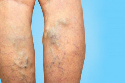 Read This Guide Opt For Varicose Vein Removal?
