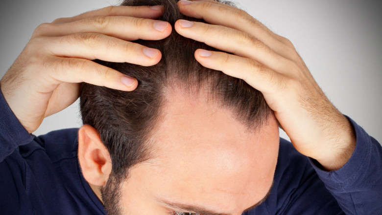 Baldness Restoration