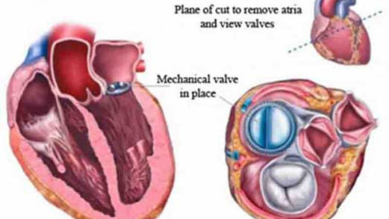 Europe Heart Valve Repair and Replacement Market 2021 Top Leading Player, Demand, Revenue, Statistics, Business Growth Analysis 2028