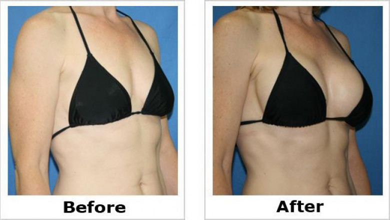 Before and After Breast Reduction Surgery