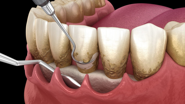 Introduction to Osseous Surgery