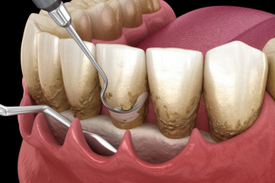 Introduction to Osseous Surgery