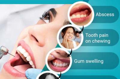 Why Do I Need Root Canal Treatment