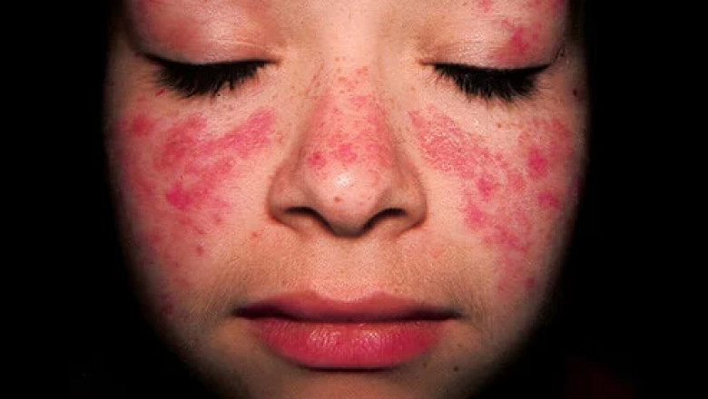 All You Should Know About Systemic Lupus Erythematosus Treatment