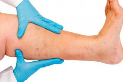 Will the 2021 Winter Season Help You To Say Goodbye To Your Veins? Know-How