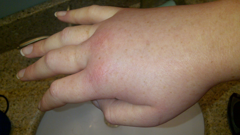 Idiopathic Congenital Angioedema (IAC), also known as Hereditary Angioedema