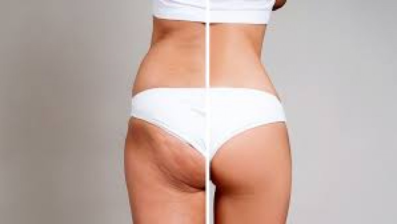 Treatment For Cellulite