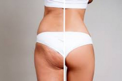 Treatment For Cellulite