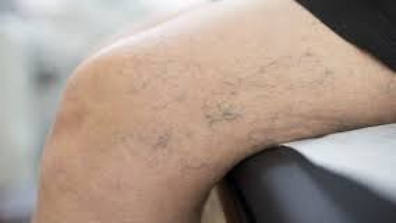 7 FAQs About Spider Vein Treatment.