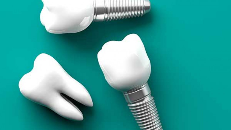 Benefits Of Getting Dental Implants