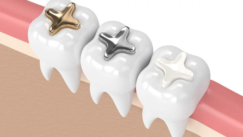 When Are Dental Fillings Needed?