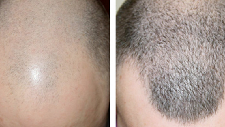 Best hair transplant clinic in Gurgaon