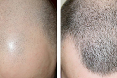 Best hair transplant clinic in Gurgaon