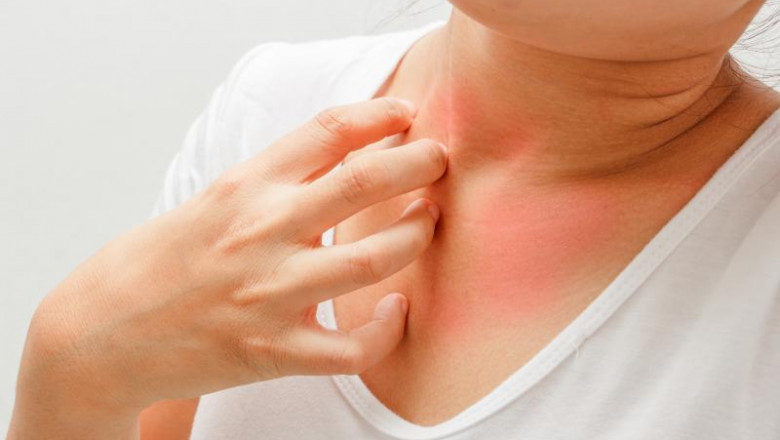 A Complete Guide To Atopic Dermatitis Drug