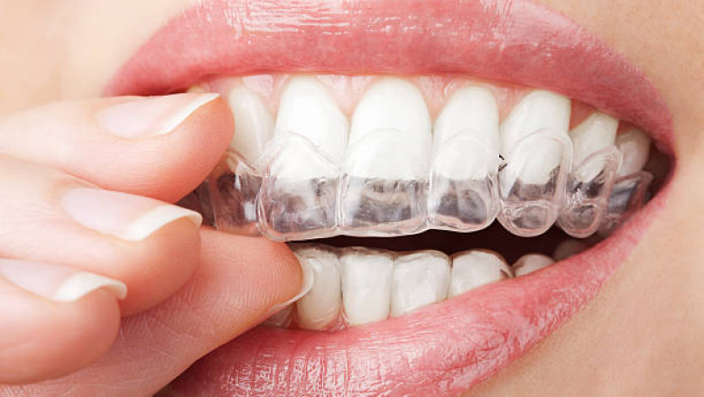 All You Need To Know About Clear Aligners