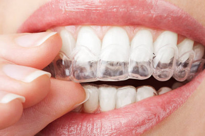 All You Need To Know About Clear Aligners