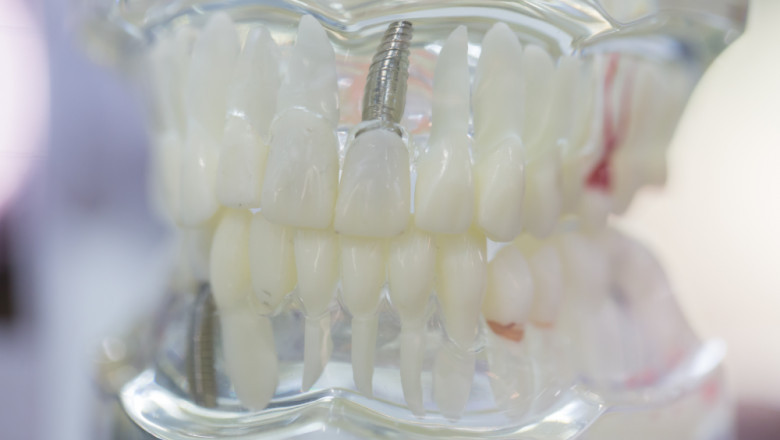 Dentist Specializing In Implants